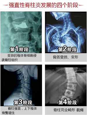 强直性脊柱炎发展的四个阶段.jpg