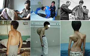 郑州痛风风湿病医院强直性脊柱炎危害患者身心健康.jpg